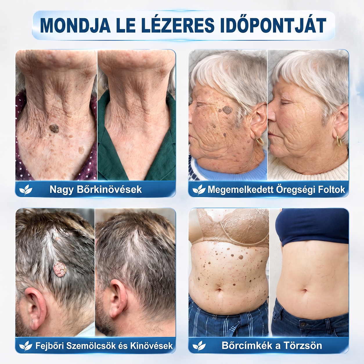 🎉 KORLÁTOZOTT IDEIG: 50% KEDVEZMÉNY 💎 Hivatalos Hiskin® üzlet | 7 napos bőrkinövés- és folteltávolító | Professzionális minőségű golyós applikátor | Fájdalommentes • Hegmentes • Arcra és testre is biztonságos