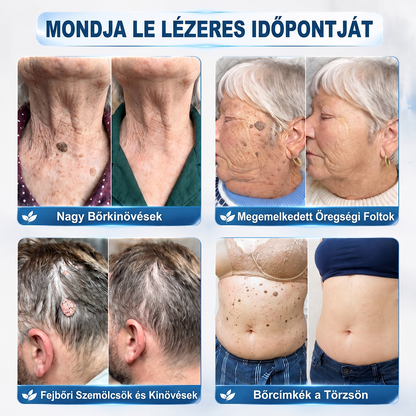 🎉 KORLÁTOZOTT IDEIG: 50% KEDVEZMÉNY 💎 Hivatalos Hiskin® üzlet | 7 napos bőrkinövés- és folteltávolító | Professzionális minőségű golyós applikátor | Fájdalommentes • Hegmentes • Arcra és testre is biztonságos