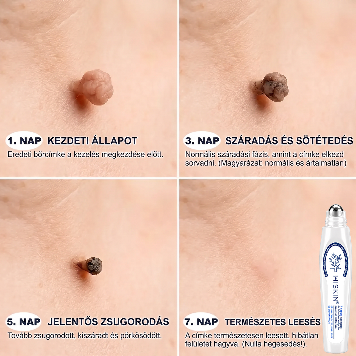 🎉 KORLÁTOZOTT IDEIG: 50% KEDVEZMÉNY 💎 Hivatalos Hiskin® üzlet | 7 napos bőrkinövés- és folteltávolító | Professzionális minőségű golyós applikátor | Fájdalommentes • Hegmentes • Arcra és testre is biztonságos